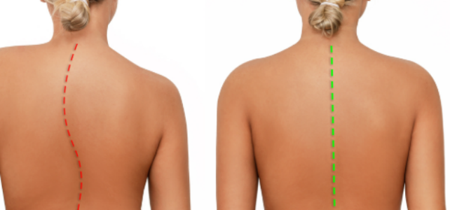 Scoliose-douleur-dos